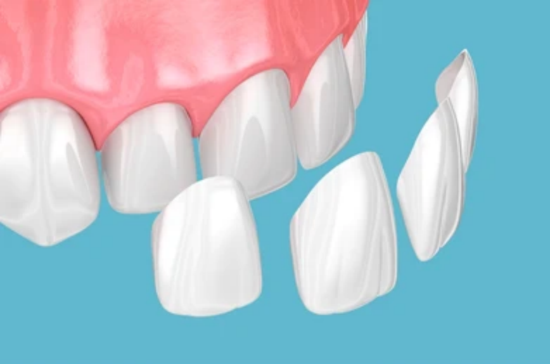 Porcelain Veneers: