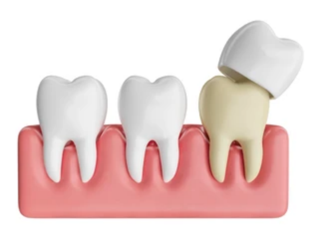 Porcelain Veneers: