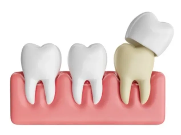 Porcelain Veneers: Porcelain Veneers: