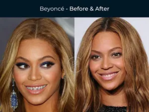Beyoncé | Jaydev Dental Beyoncé