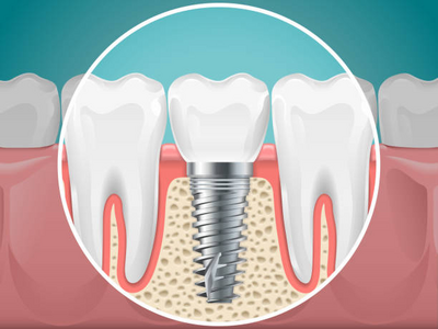 Dental Implants