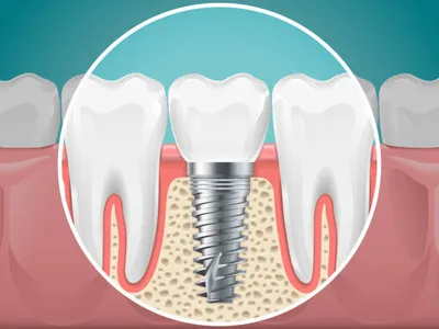 Dental-Implants | Jaydev Dental Dental Implants