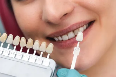 Veneers | Jaydev Dental Veneers