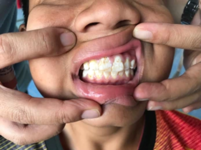 What Is Dental Fluorosis?