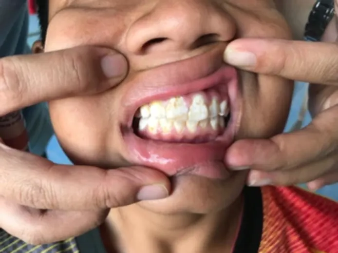 What Is Dental Fluorosis? What Is Dental Fluorosis?