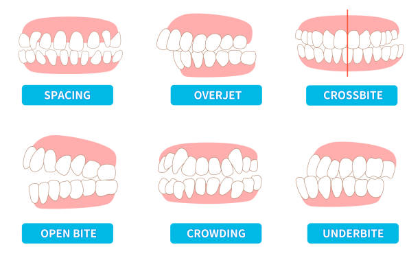 What is Maxillary Protrusion