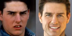 Tom-Cruise | Jaydev Dental Tom Cruise