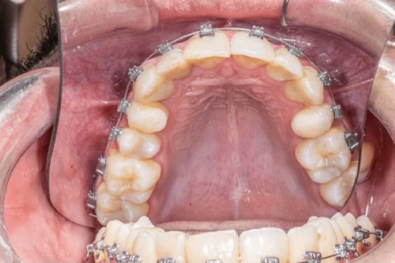 Best Treatment Options for Maxillary Protrusion in India