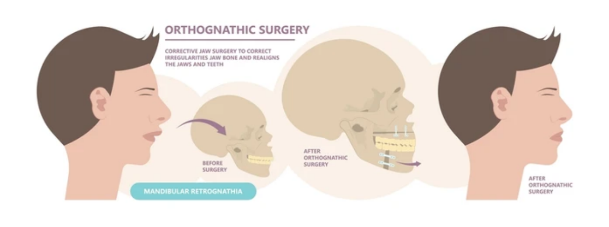 Surgical Intervention