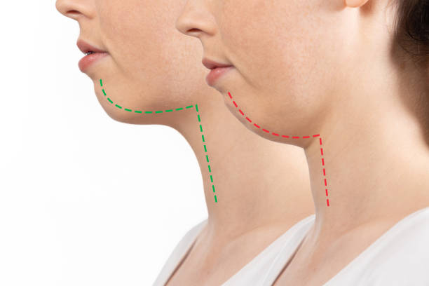 Benefits of Maxillary Protrusion Treatment