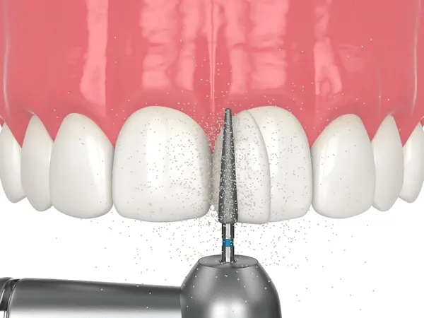 Dental-Bonding: | Jaydev Dental Dental Bonding: