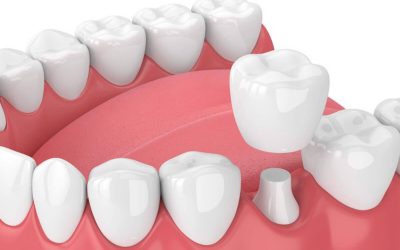 Dental Crowns and Bridges