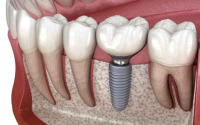 Dental Implants