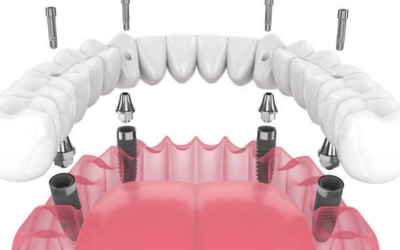 Dental Implants