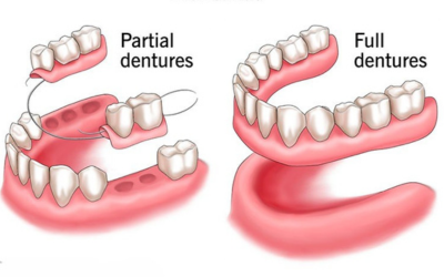 Full and Partial Denture