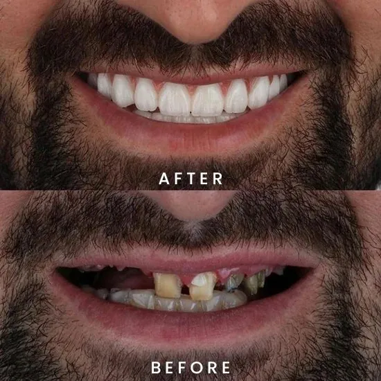 FullMouth-Before-and-After FullMouth-Before-and-After