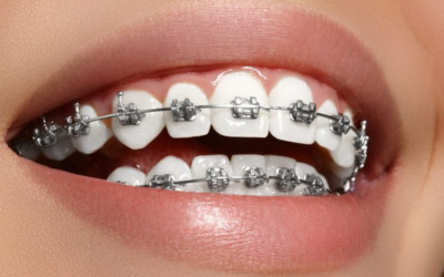 Orthodontic Treatments