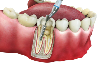 Root Canal Treatment