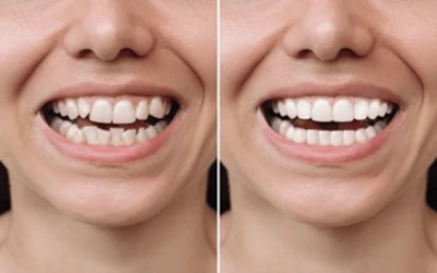 Veneers and Bonding