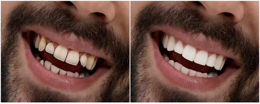 What is Full Mouth Rehabilitationn