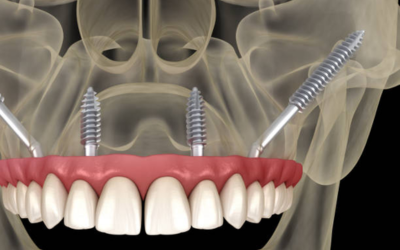 Dental Implants