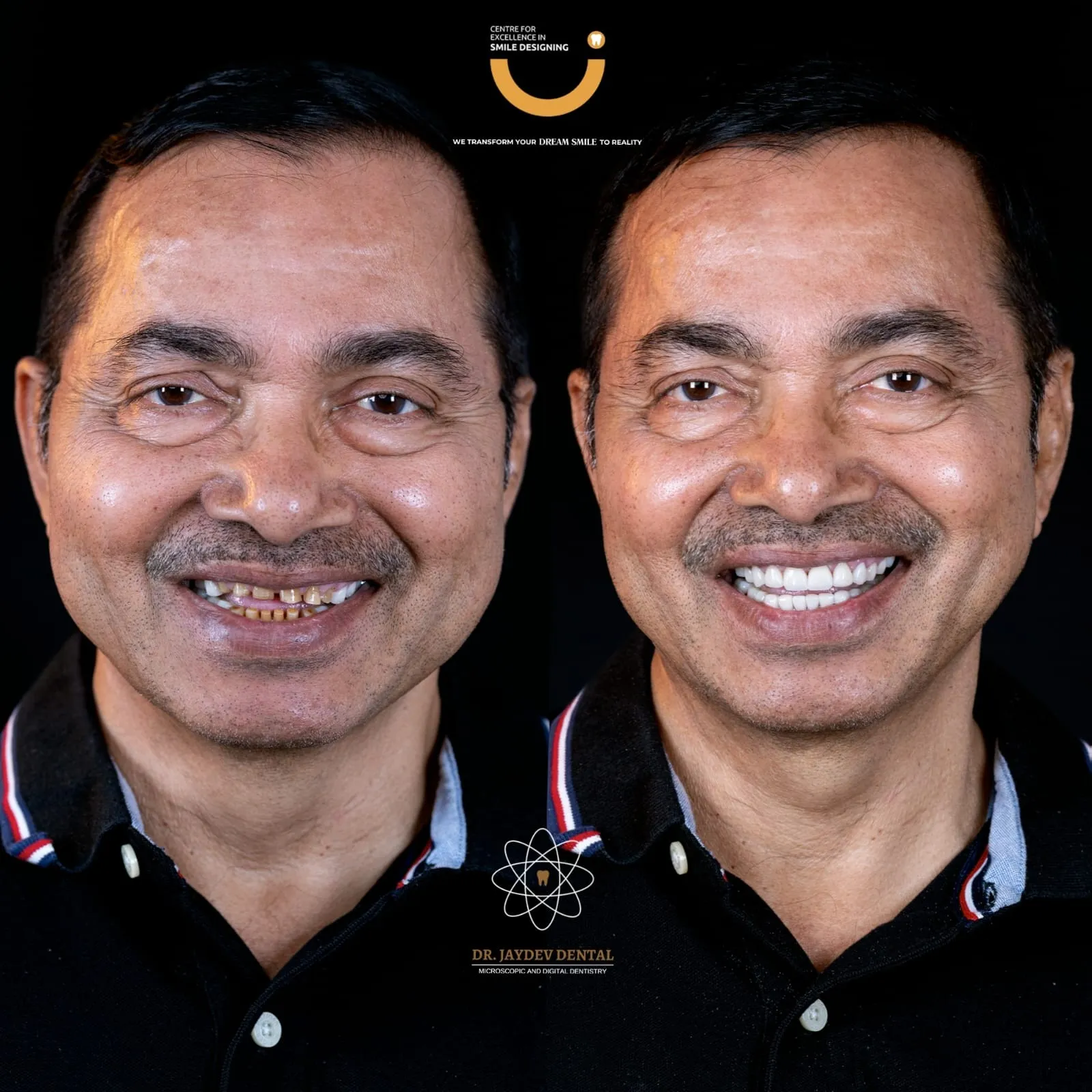dr_jaydev | Jaydev Dental Full-Mouth Rehabilitation before & after