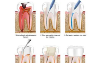 Painless Root Canal Treatment | Jaydev Dental Fillings