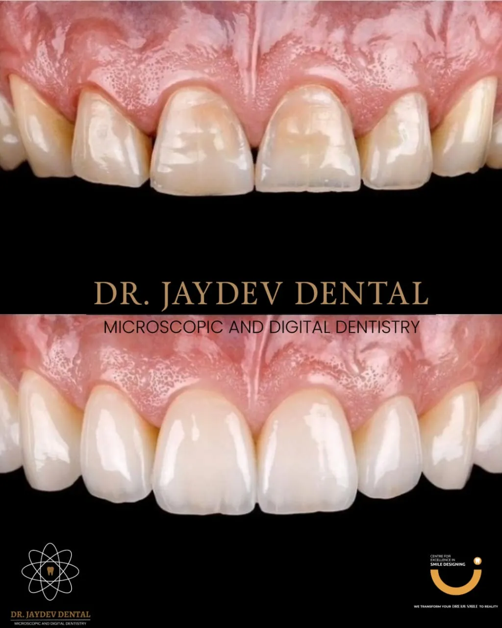Our Approach for Dental Veneers