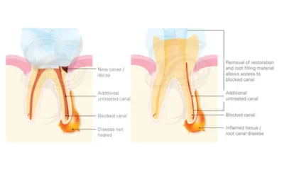 Root-Canal-Retreatment | Jaydev Dental Fillings