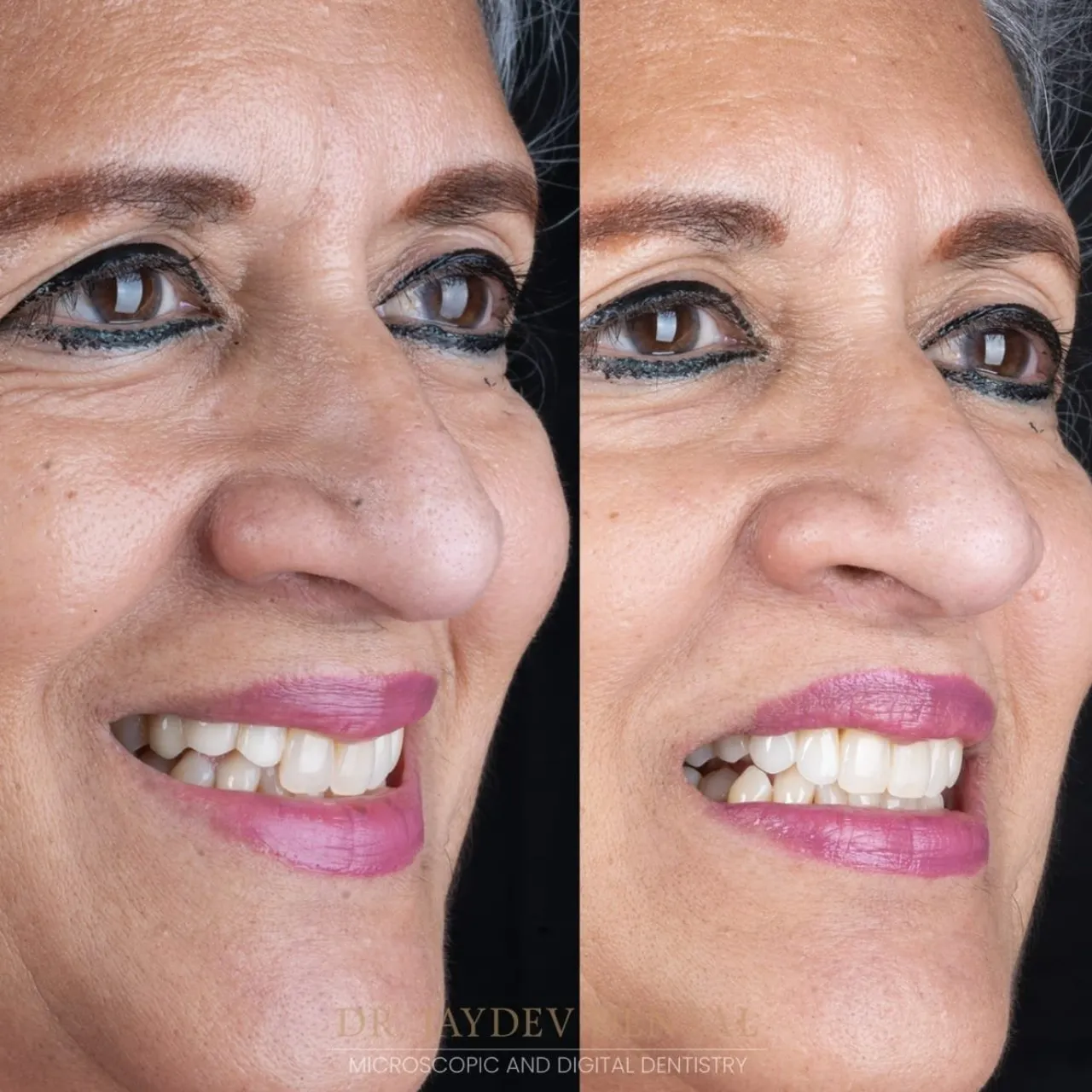 smile-makeover-before-after smile-makeover-before-after