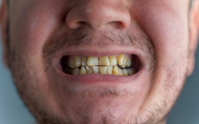 Discolored or Stained Teeth
