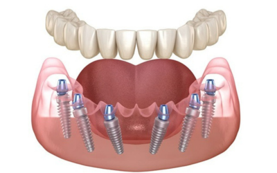 Full Mouth Rehabilitation