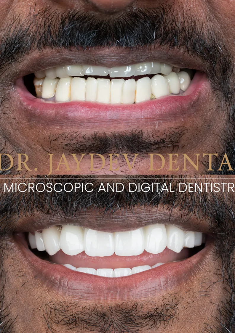 John-miller-smile-designing-before-after