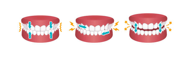 Dental veneers