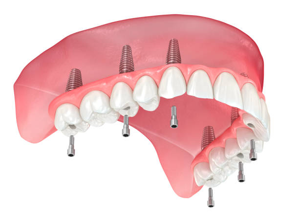 Full Mouth Dental Implants