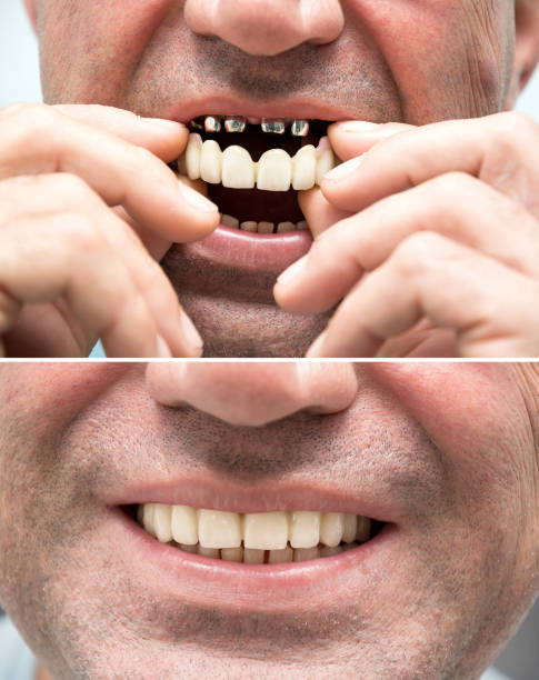 Zirconia Full Mouth Dental Implants Before & After