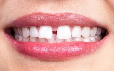Dental-Bonding | Jaydev Dental Dental Veneers