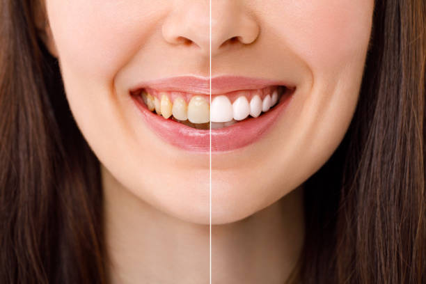 Smiling triggers the release of dopamine and serotonin, your brain’s feel-good chemicals.