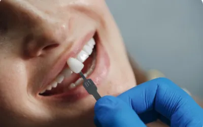 Dental Bonding and Veneers | Jaydev Dental