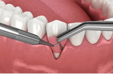 Picture31 | Jaydev Dental