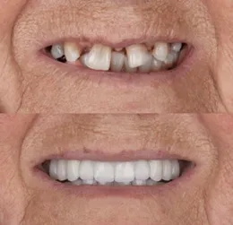 Picture41 | Jaydev Dental