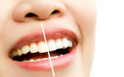 Teeth Whitening | Jaydev Dental