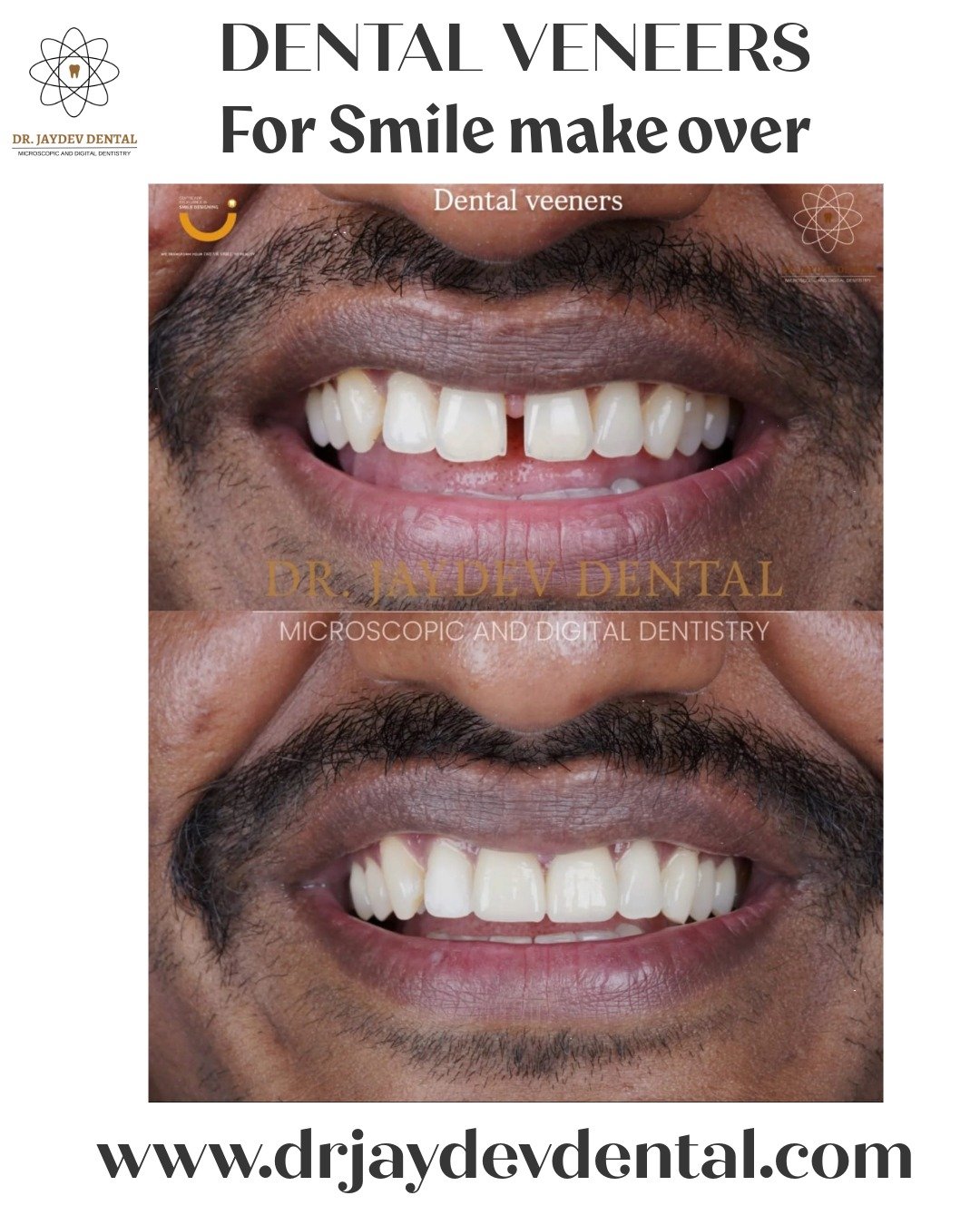 Dental-veneers-for-smile-makeover-in-hyderabad