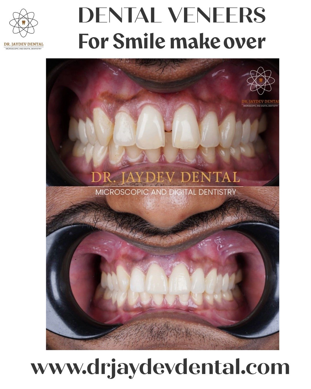Dental-veneers-for-smile-makeover-in-hyderabad