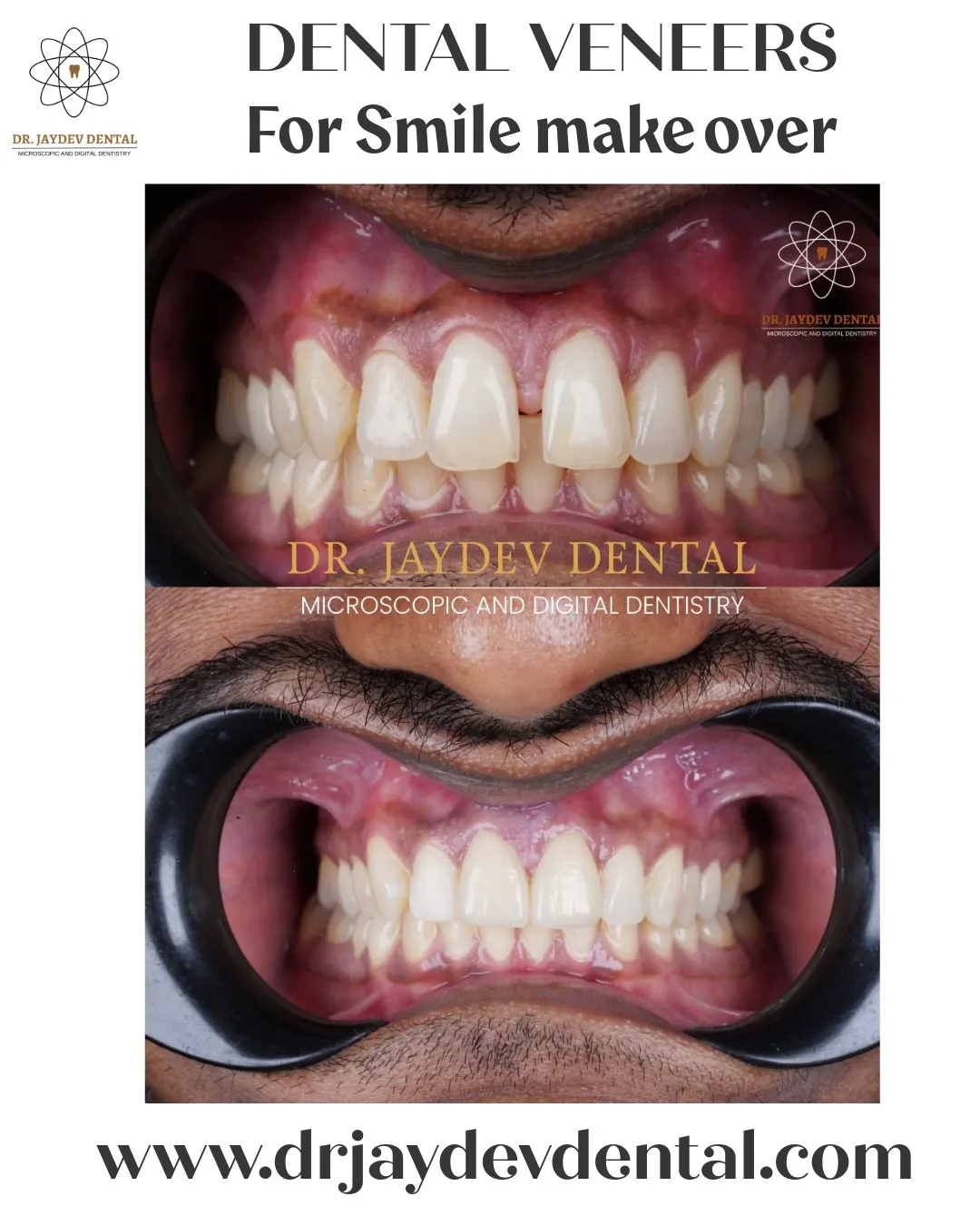 WhatsApp Image 2025-07-16 at 163607 Dental-veneers-for-smile-makeover-in-hyderabad