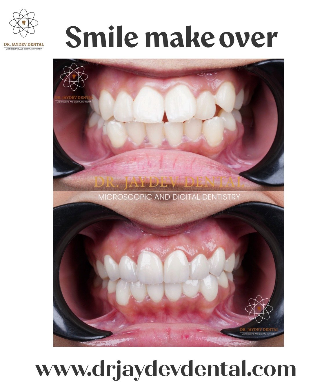 smile-makeover-in-hyderabad