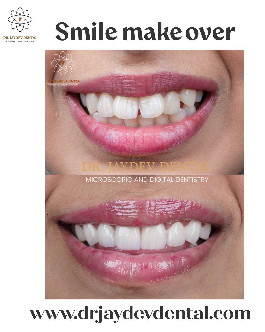 Smile-makeover-in-hyderabad