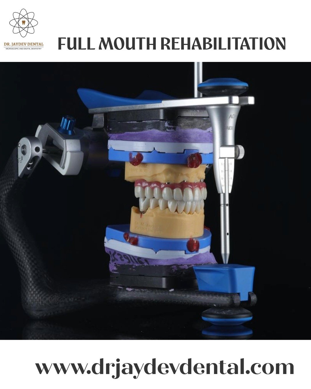 Full-mouth-rehabilitation-in-hyderaabd