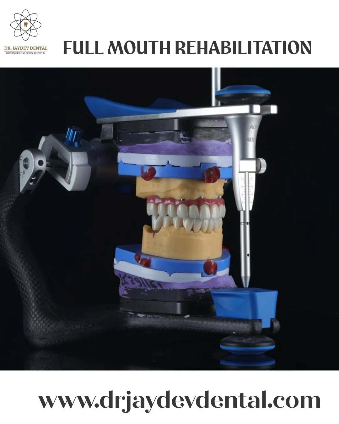 WhatsApp Image 2025-07-16 at 164153 1 Full-mouth-rehabilitation-in-hyderaabd