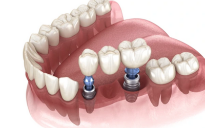 Implants or Bridges